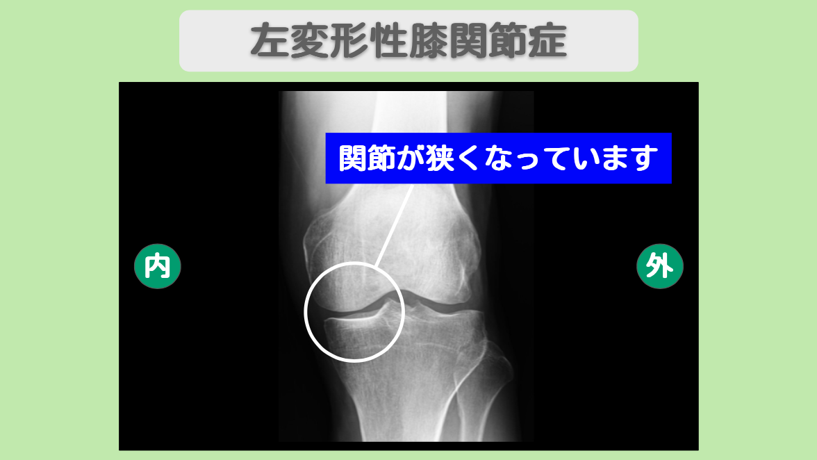 変形性膝関節症