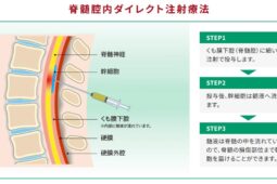 脊髄腔内ダイレクト注射療法
