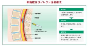 脊髄腔内ダイレクト注射療法