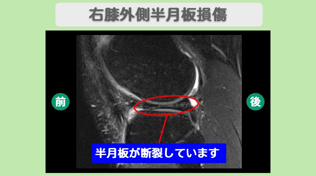右膝外側半月板損傷
