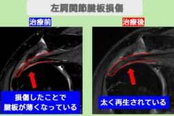 右肩腱板損傷