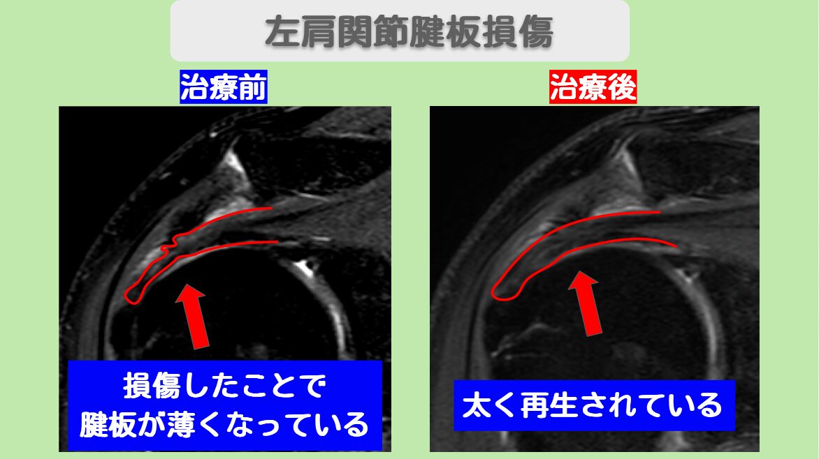 右肩腱板損傷