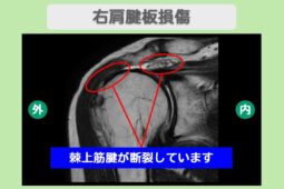 肩腱板損傷