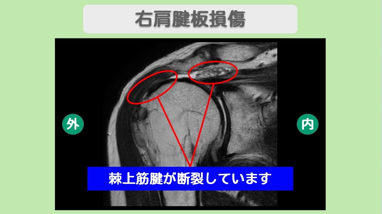 肩腱板損傷