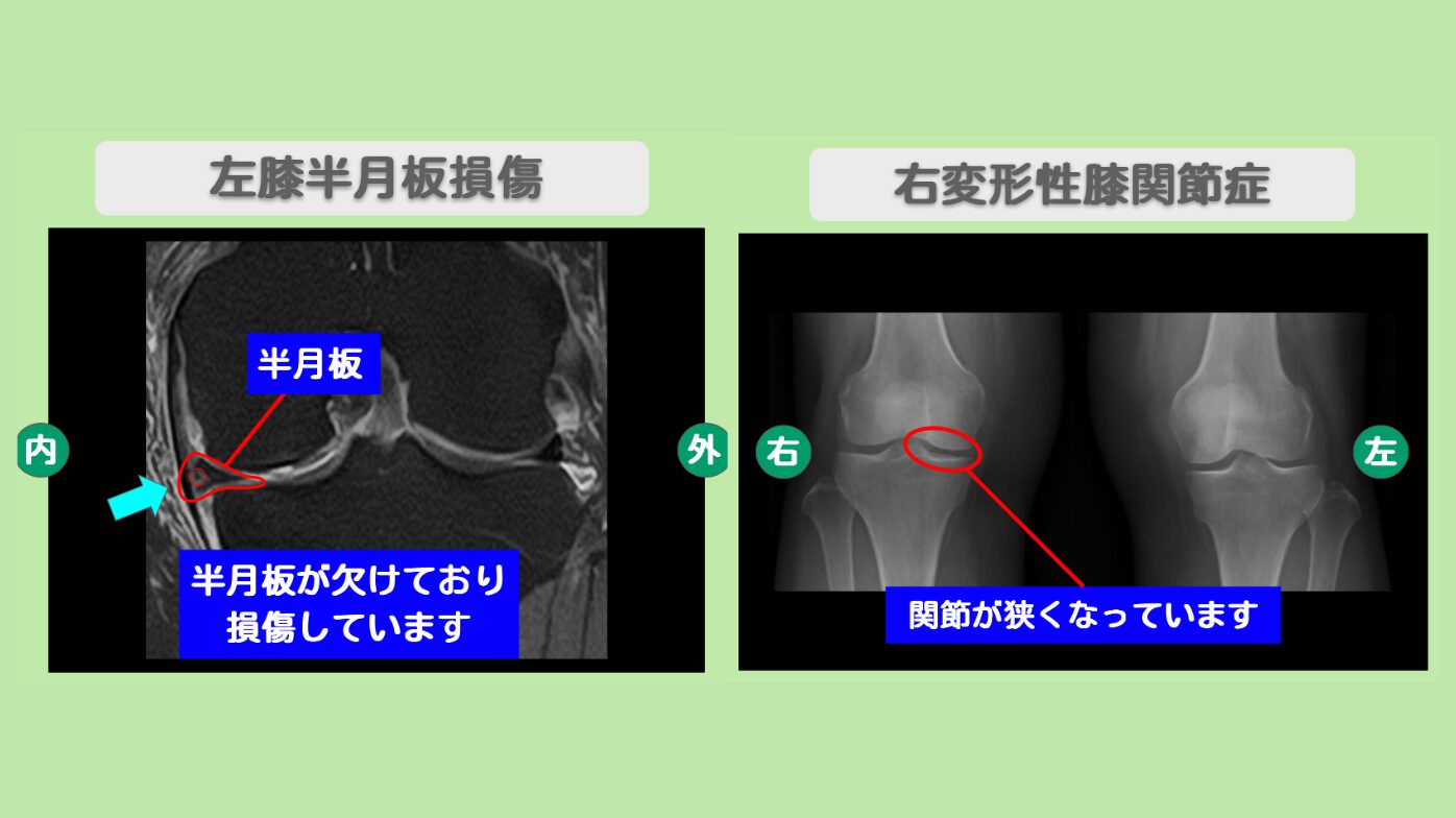 左半月板損傷・右変形性膝関節症