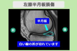 左膝半月板損傷
