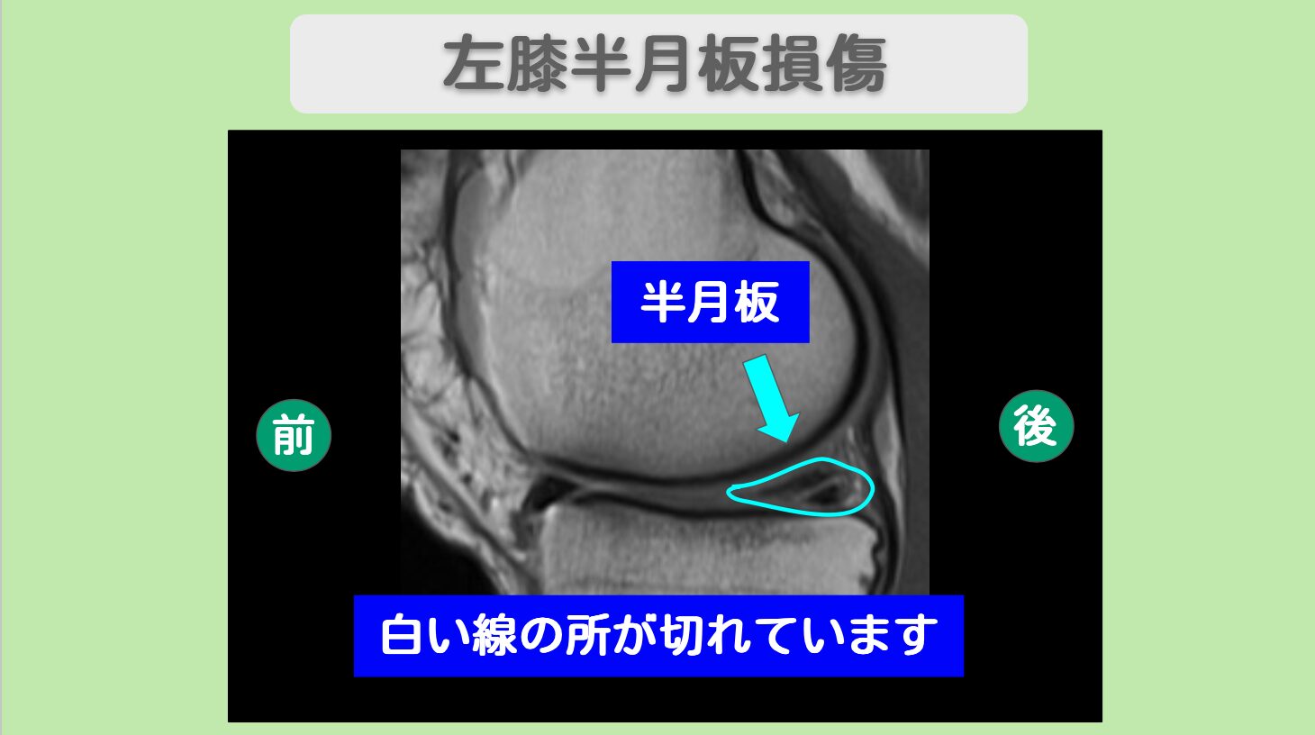 左膝半月板損傷