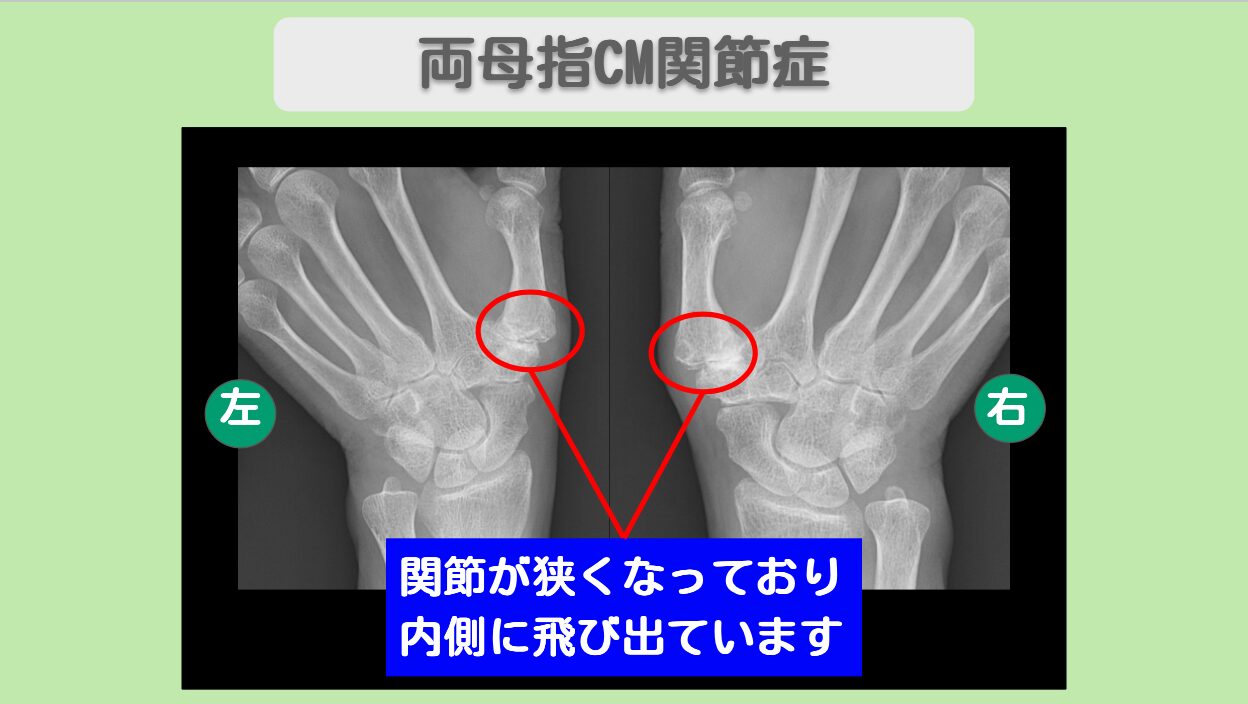 両母指CM関節症
