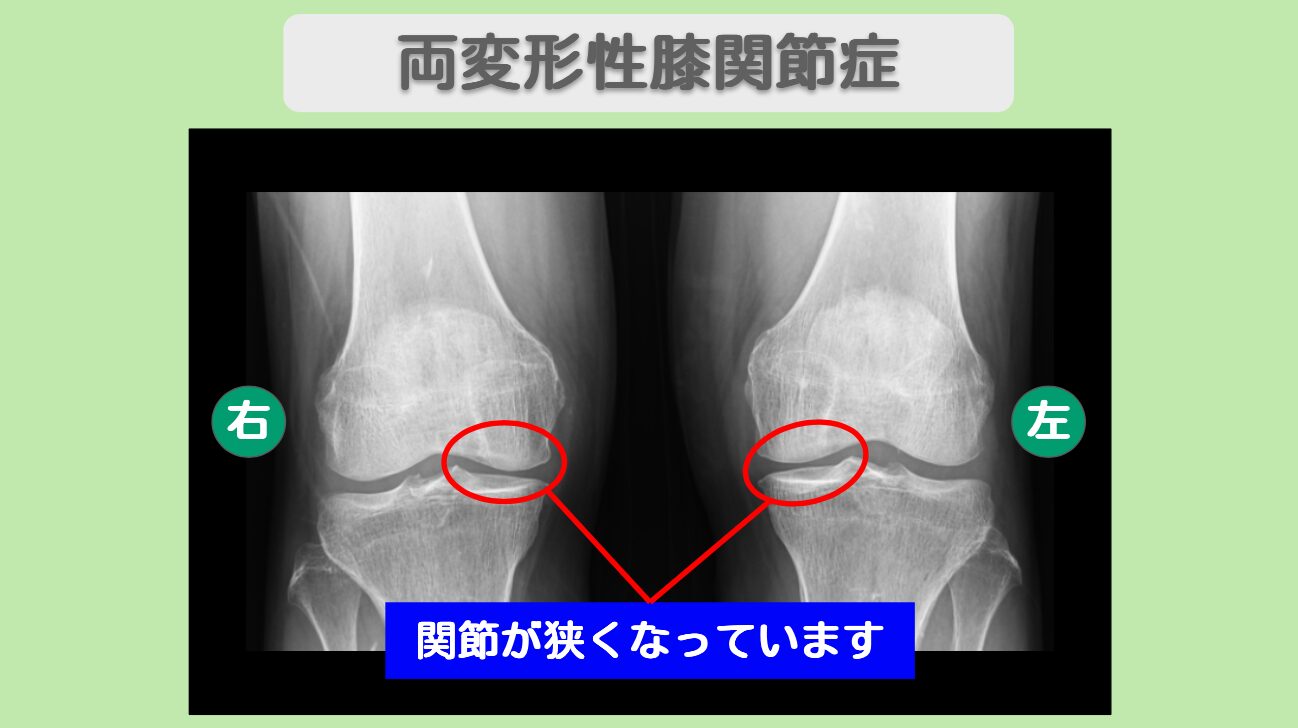 変形性膝関節症