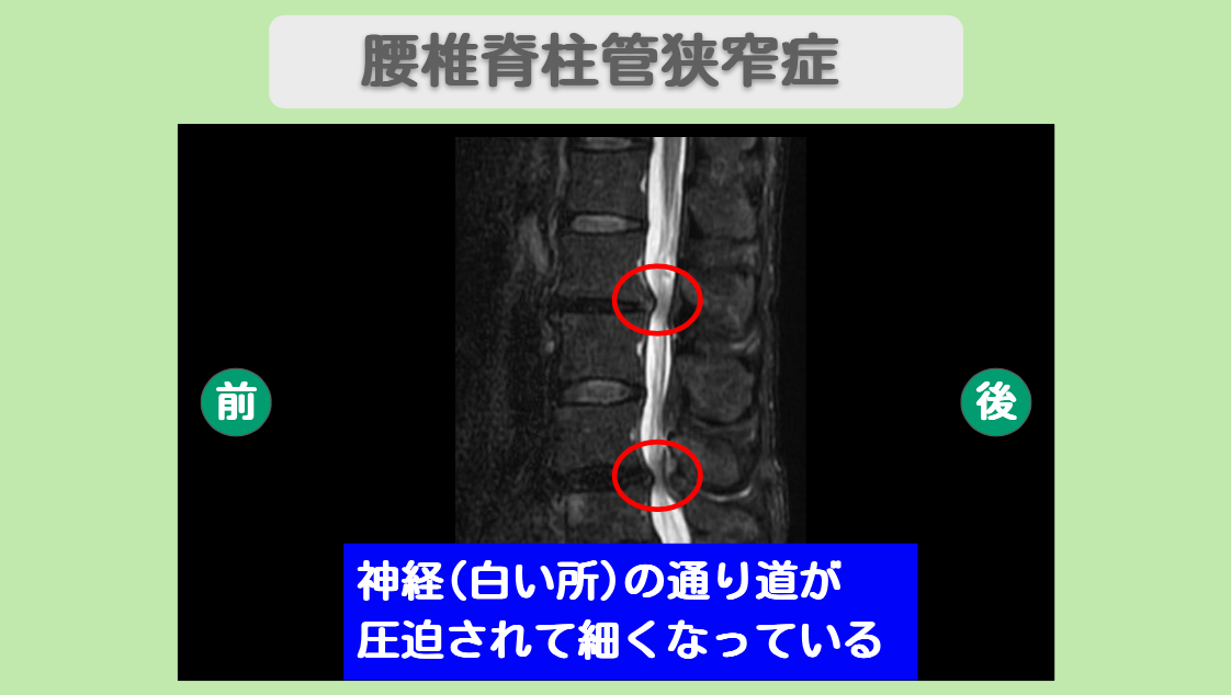 腰椎脊柱管狭窄症