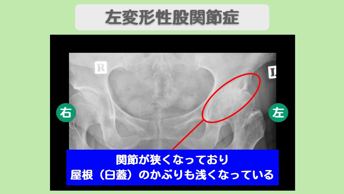 左変形性股関節症