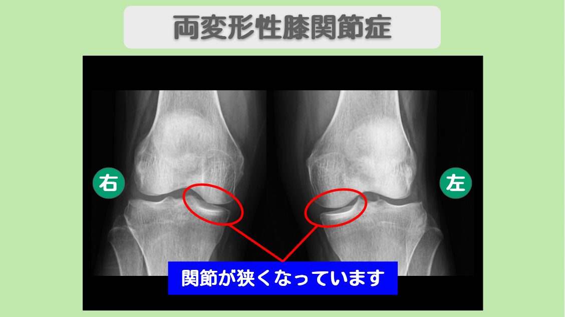 変形性膝関節症