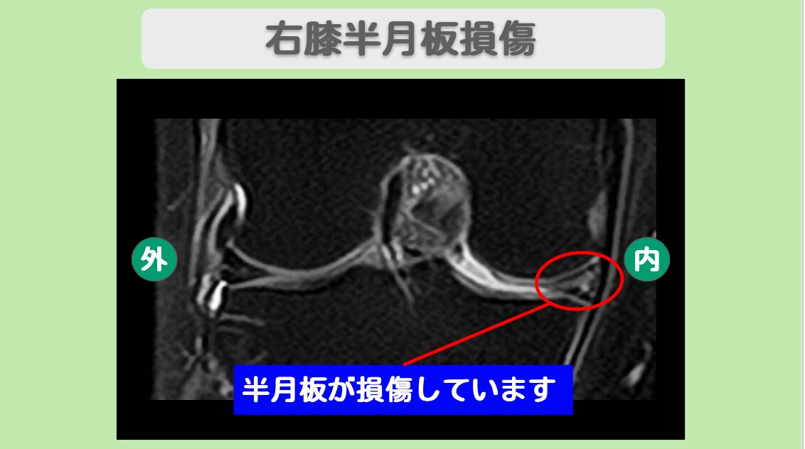 半月板損傷