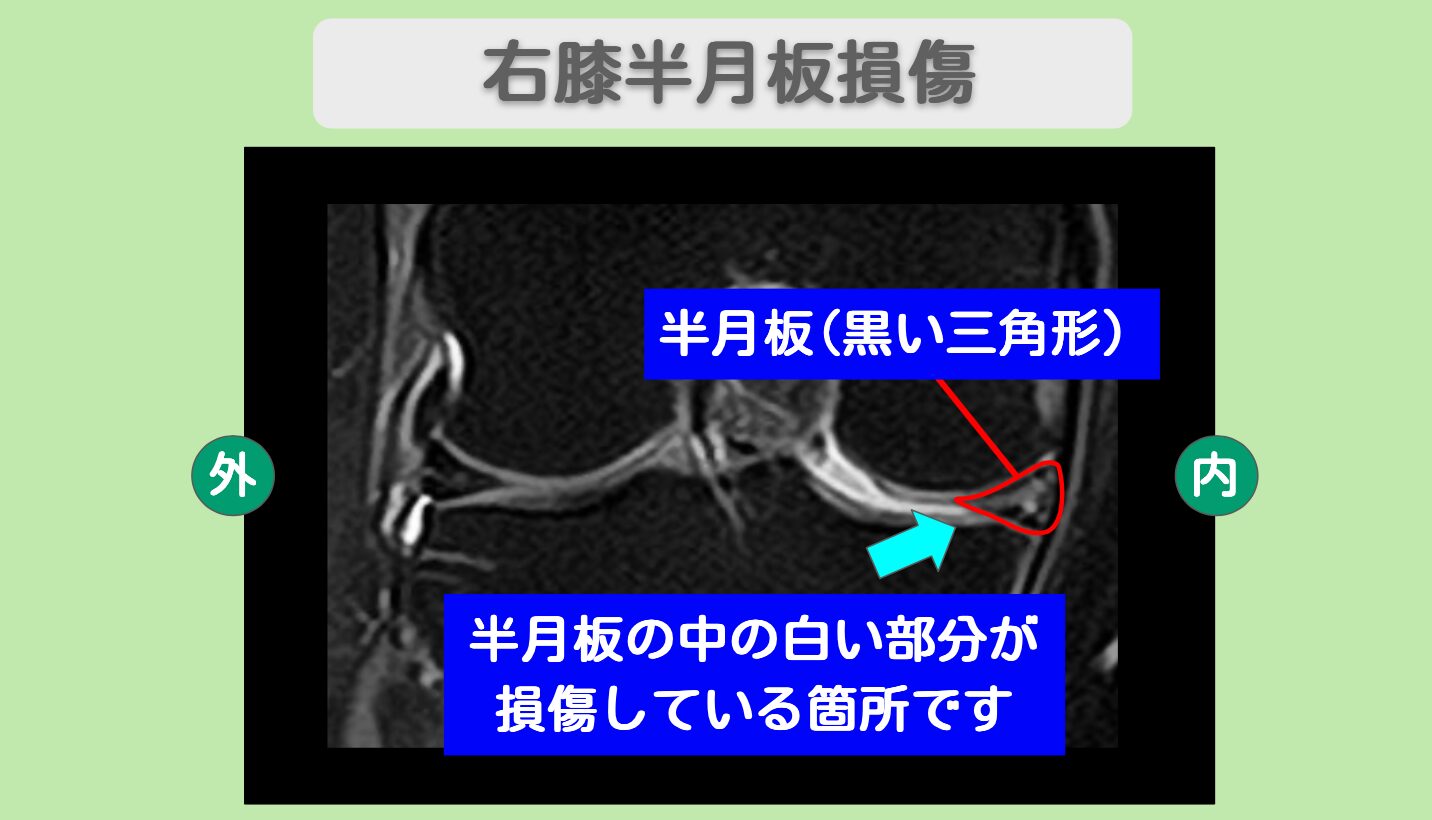 半月板損傷