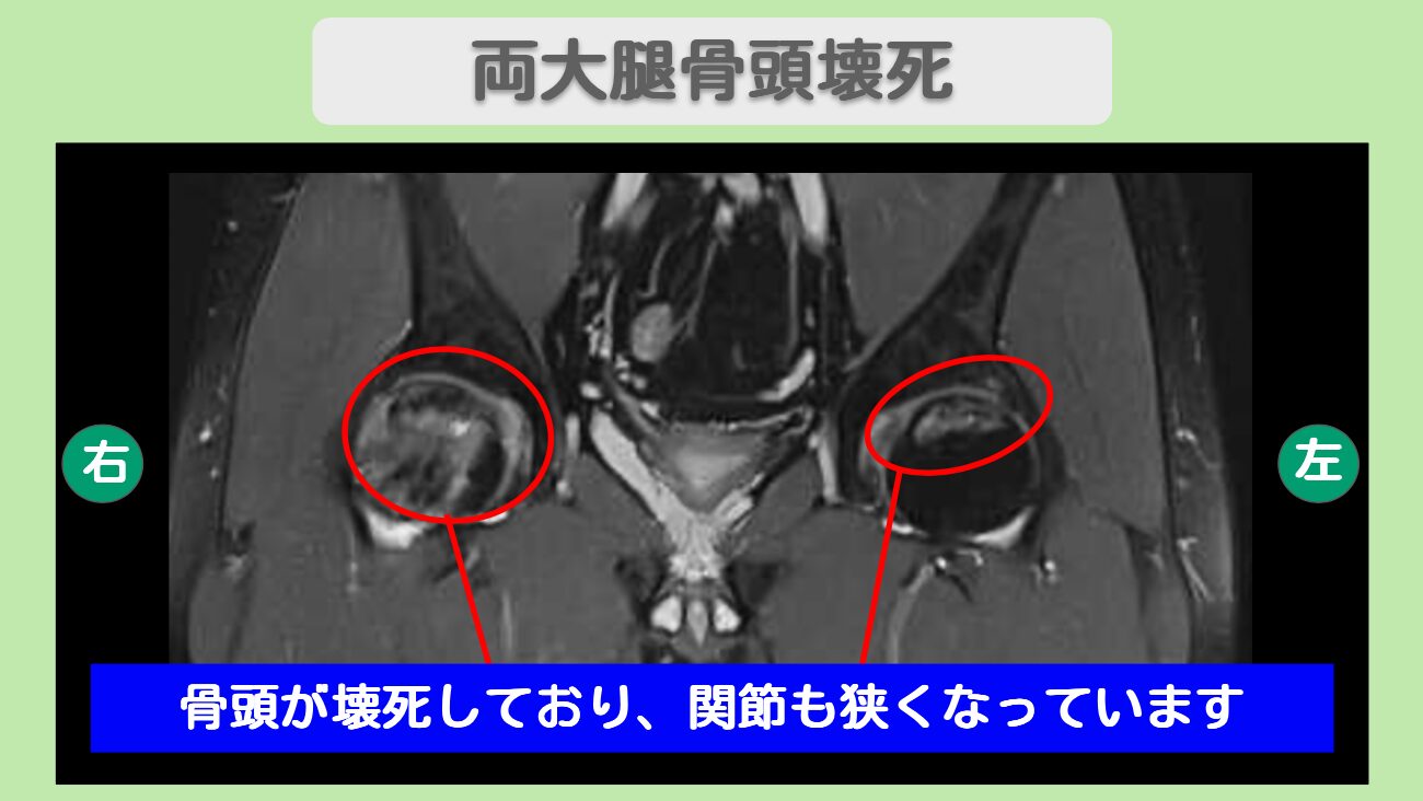 大腿骨頭壊死