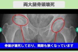 大腿骨頭壊死