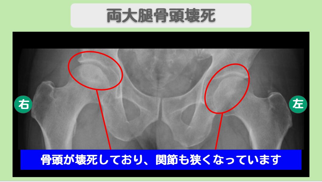 大腿骨頭壊死
