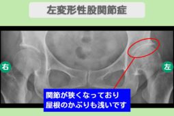 変形性股関節症