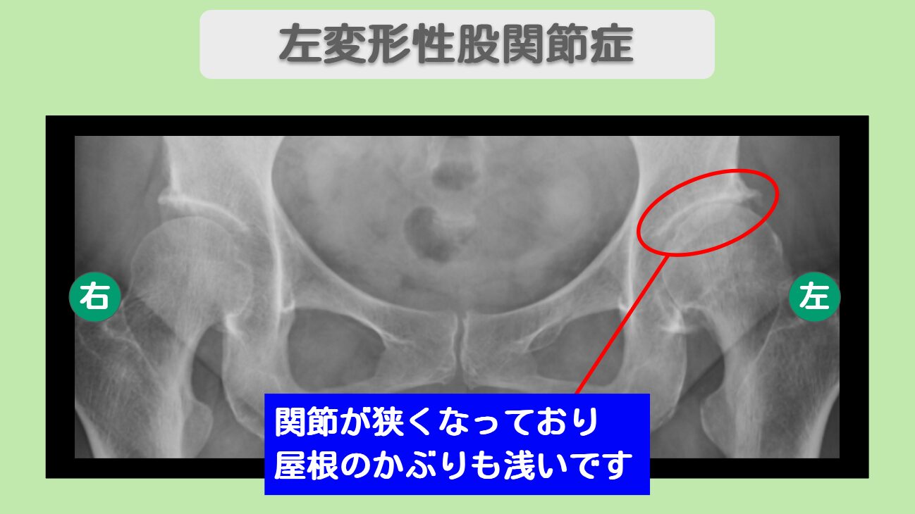 変形性股関節症