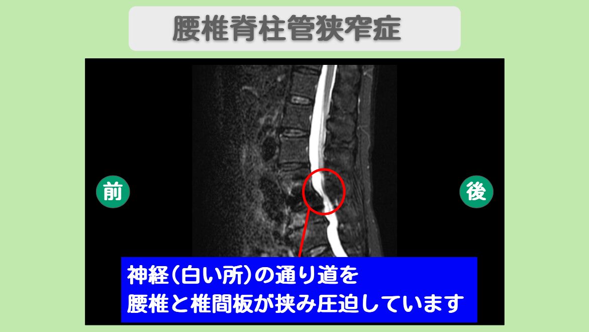腰部脊柱管狭窄症術後