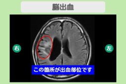 脳出血