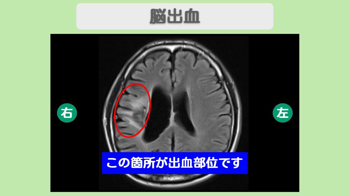 脳出血