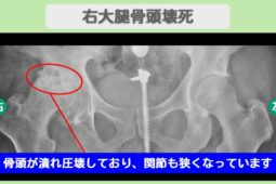 大腿骨頭壊死