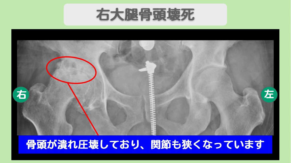 大腿骨頭壊死