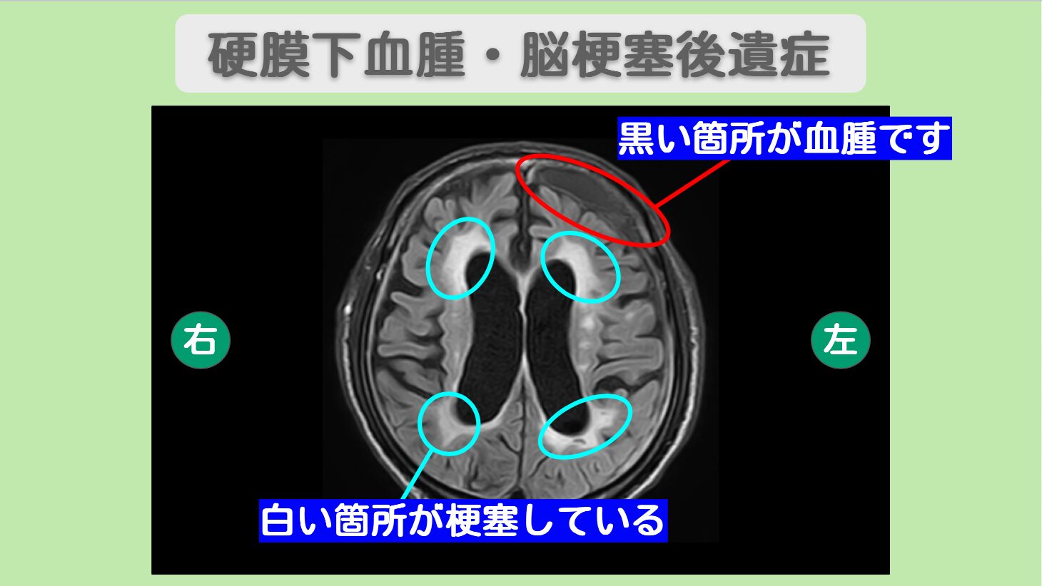 脳梗塞 硬膜下血腫