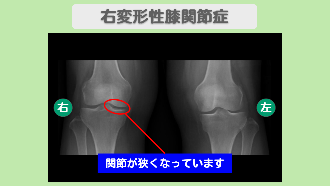 変形性膝関節症