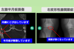 半月板損傷　変形性膝関節症