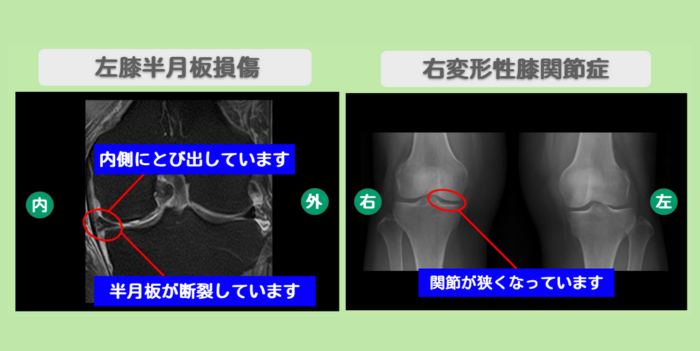半月板損傷　変形性膝関節症