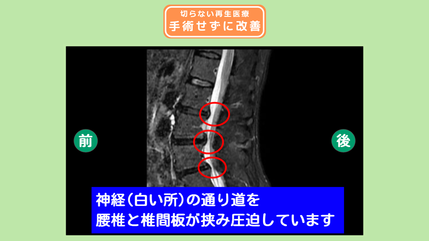 腰椎椎間板ヘルニア