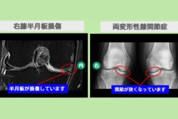 右膝半月板損傷・両変形性膝関節症