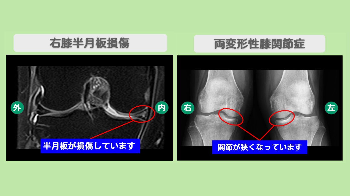 右膝半月板損傷・両変形性膝関節症