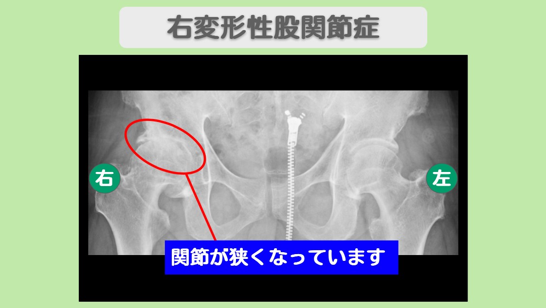 変形性股関節症