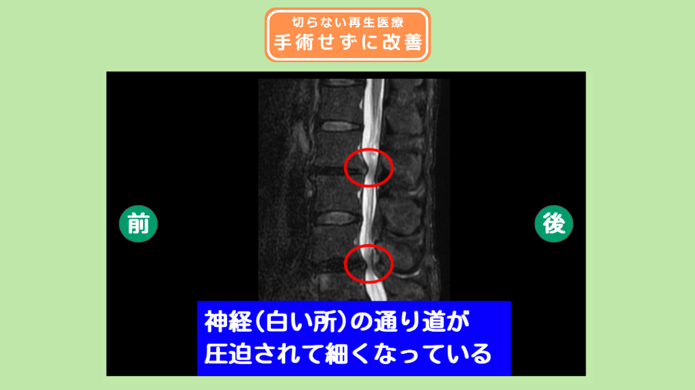 腰椎脊柱管狭窄症