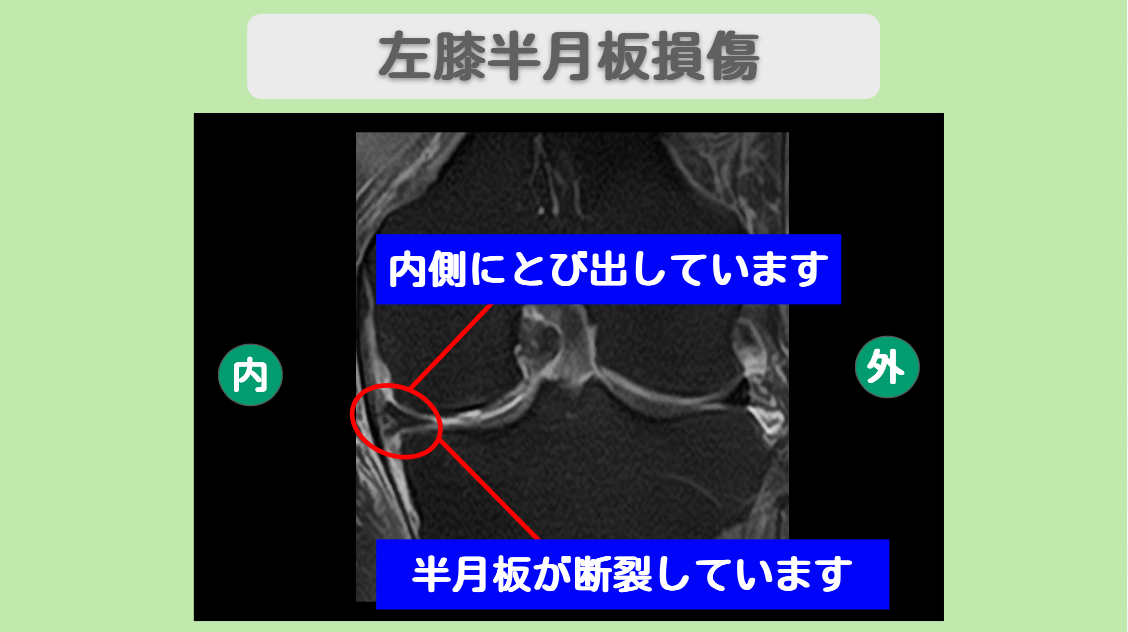 半月板損傷