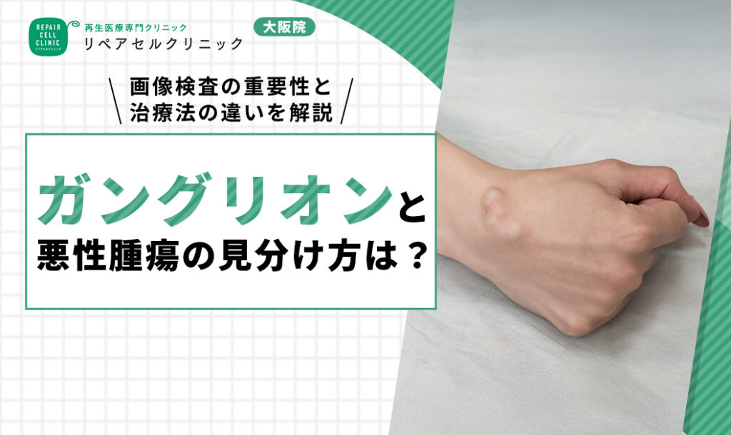 ガングリオン 悪性 画像