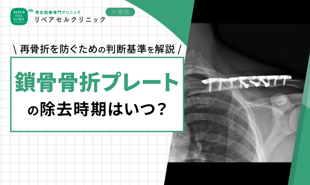 鎖骨骨折プレートの除去時期はいつ?再骨折を防ぐための判断基準を解説