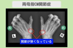 両母指CM関節症