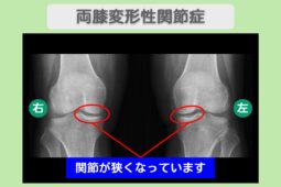 両変形性膝関節症