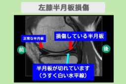 半月板損傷