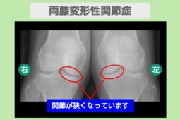 両変形性膝関節症
