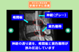腰椎脊柱管狭窄症