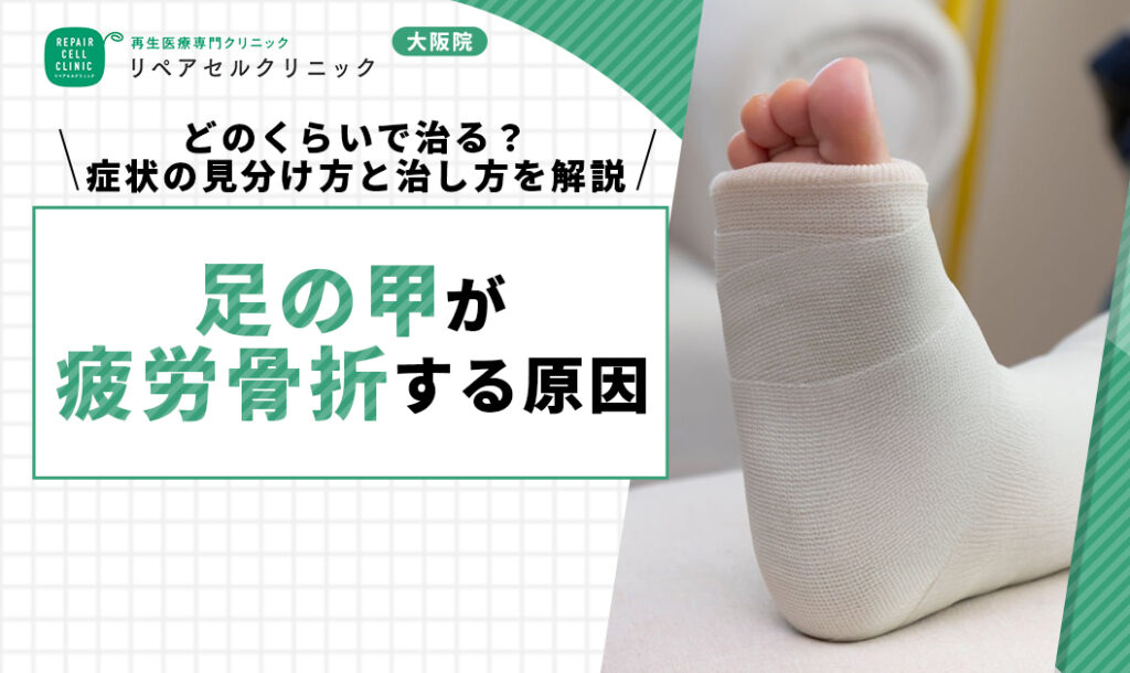 足の甲が疲労骨折する原因|どのくらいで治る?症状の見分け方と治し方を解説