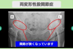 変形性股関節症