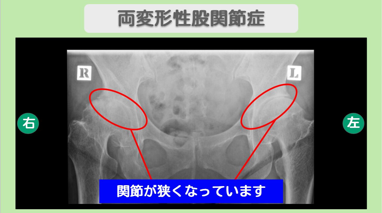 変形性股関節症