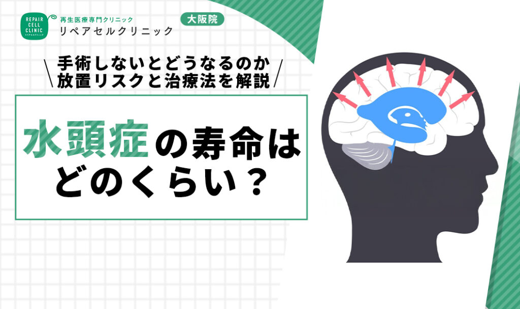 水頭症の寿命はどのくらい?手術しないとどうなるのか、放置リスクと治療法について解説