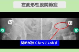 変形性股関節症